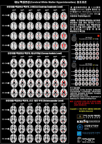 뇌경색 위험 예측을 위한 한국인 허혈 뇌지도 사진